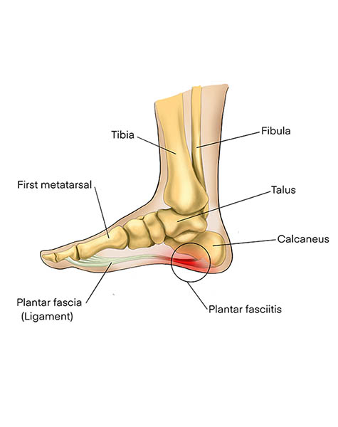 fascitis platar castellón